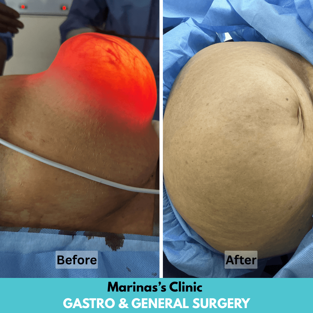 After hernia treatment result