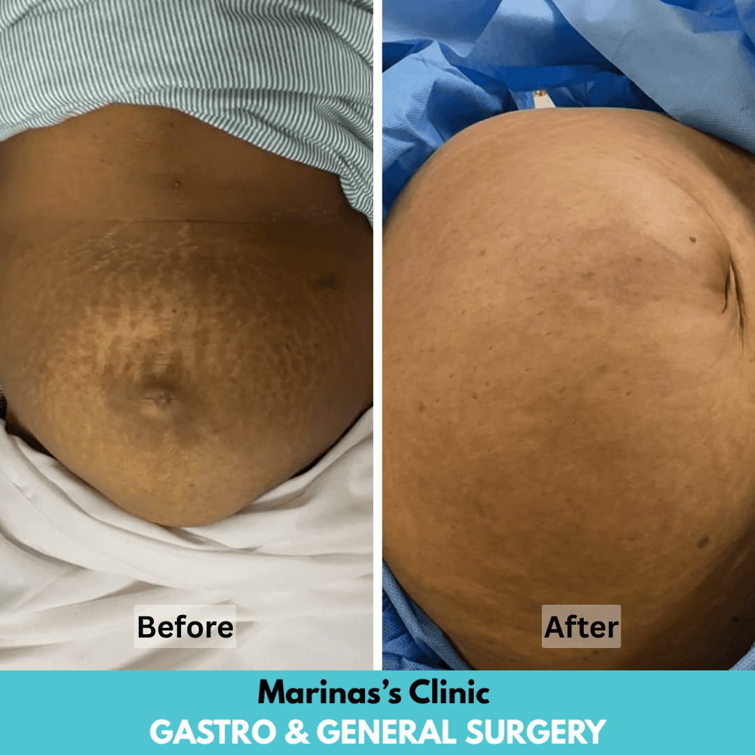 After hernia treatment result