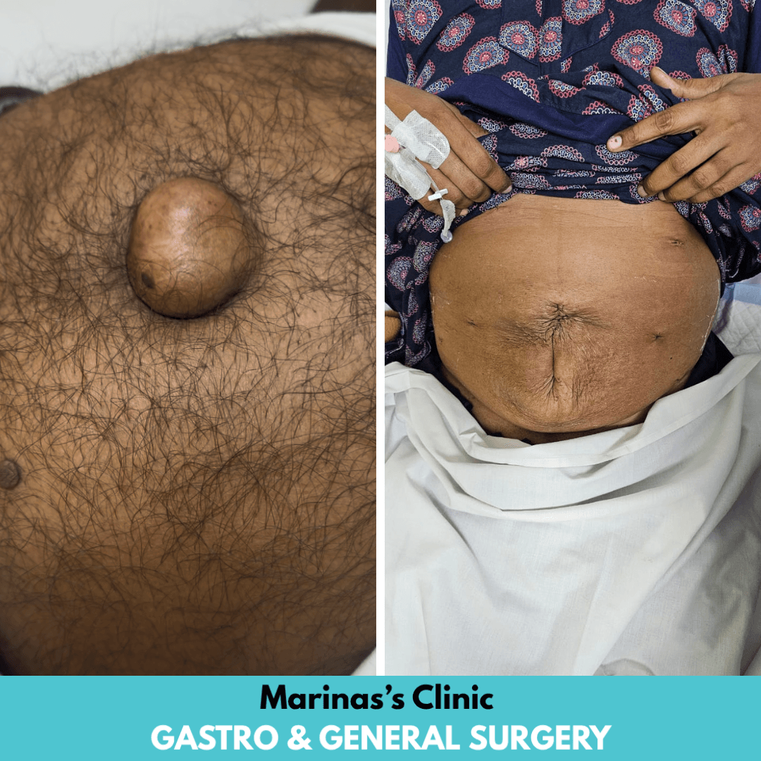 After hernia treatment result