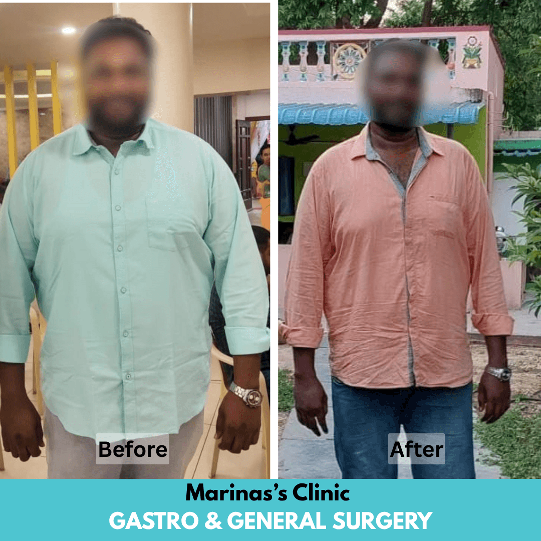 Before hernia treatment result