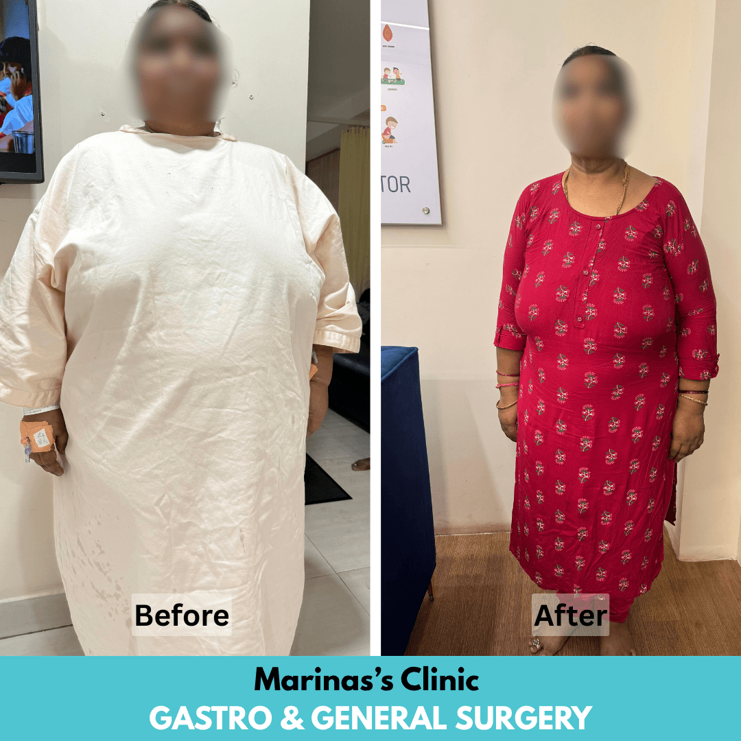 Before hernia treatment result